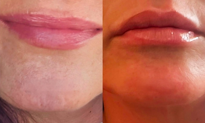Image 4: Natural-Looking Rejuvenation with Evolysse & Lip Fillers