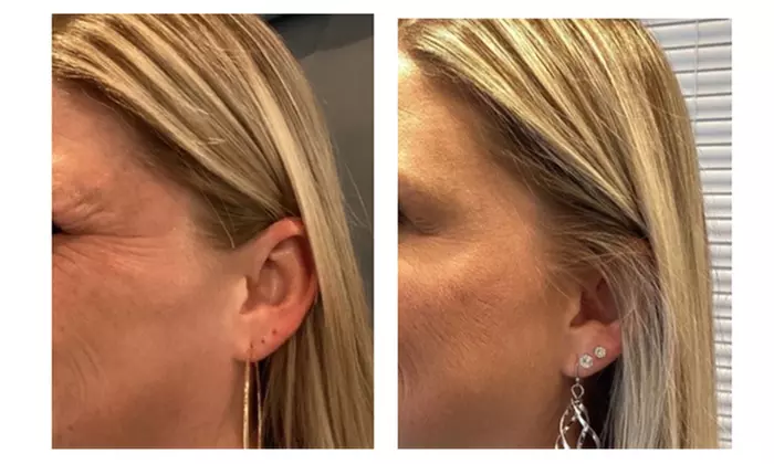 Achieve a Youthful Look with 20 Units of Botox