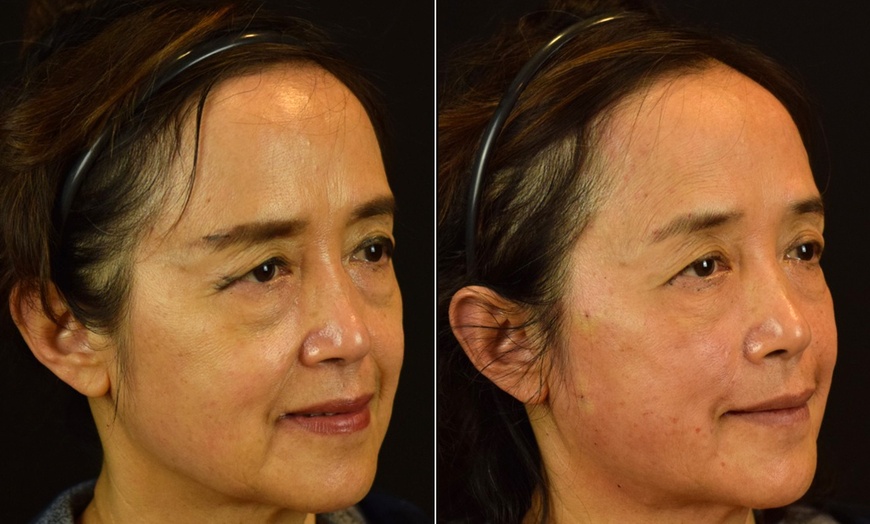Image 3: One Microneedling Treatment with PRND, HA or Exosomes for Full Face