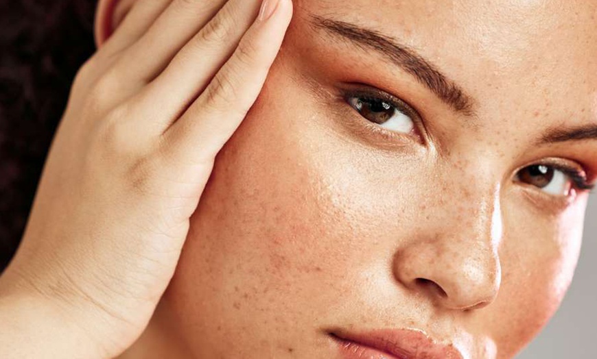 Image 4: Revitalise Your Complexion with Luxury Laser & Skin Facials