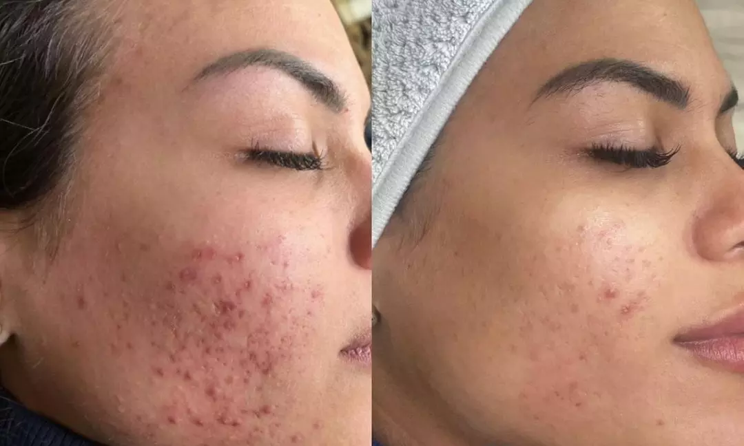 Permanent Makeup & Advanced Microchanneling