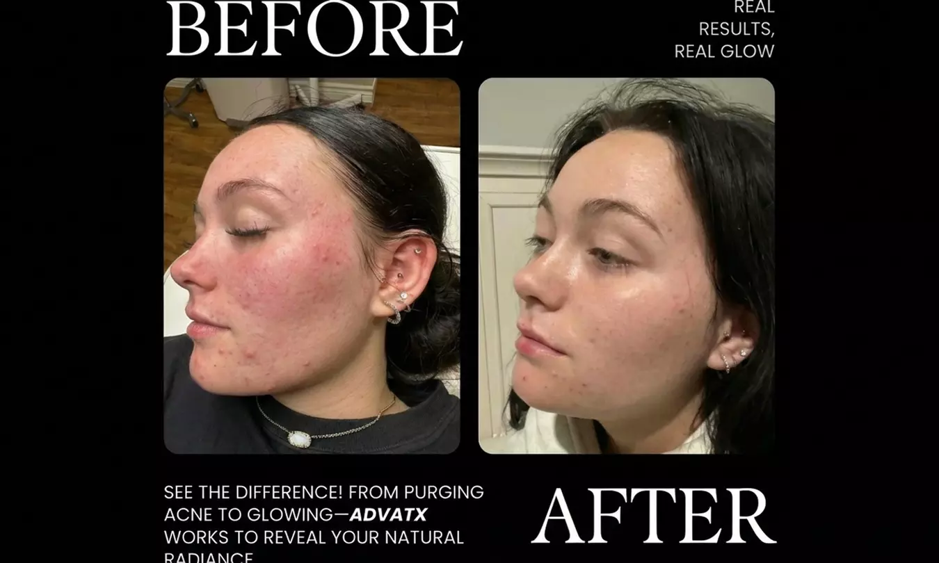 1, 2 or 3 45-Min AdvaTX Laser Skin Resurfacing & Rejuvenation Sessions