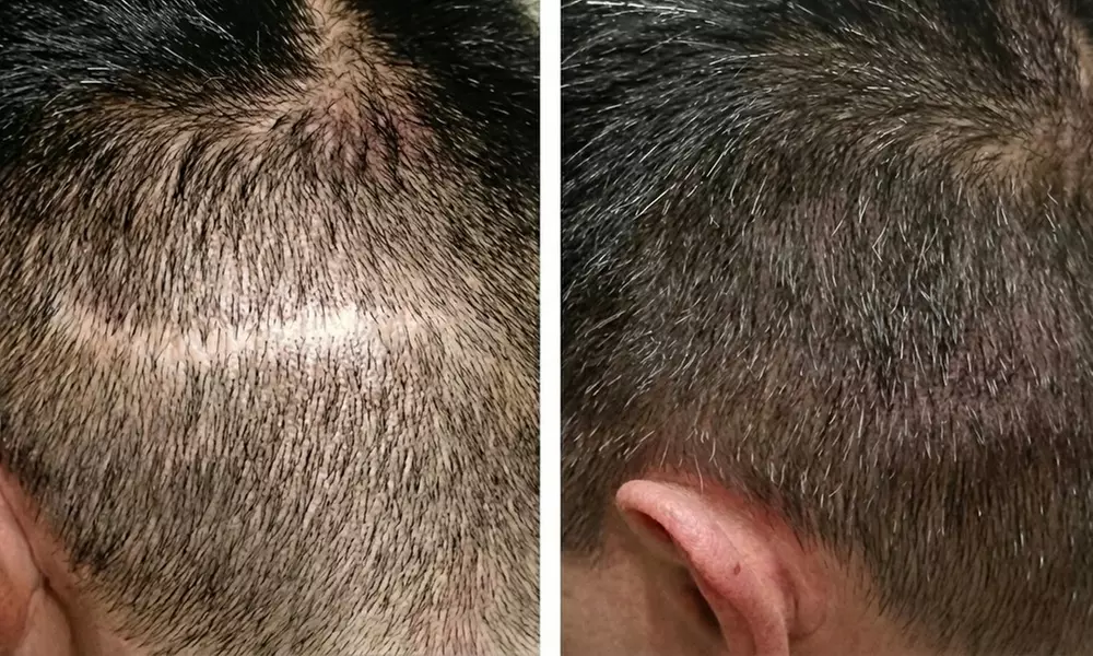 Hair Restoration Scalp Micropigmentation : 1 Spot/Partial or Full Head
