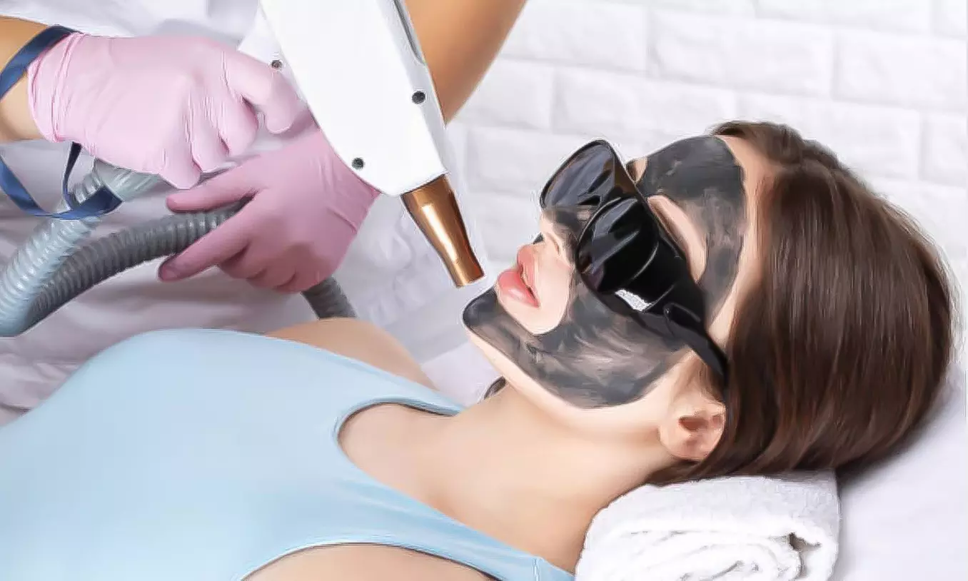 Hollywood peeling con mascarilla de carbón activo y láser