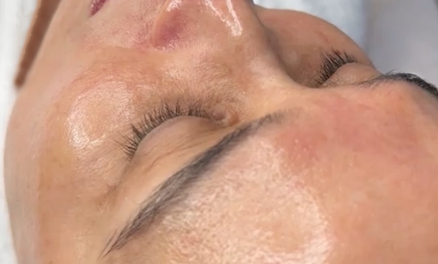 Image 9: CO2 Skin Rejuvenation for Face, Neck, & Eyes