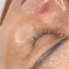 Image 9: CO2 Skin Rejuvenation for Face, Neck, & Eyes