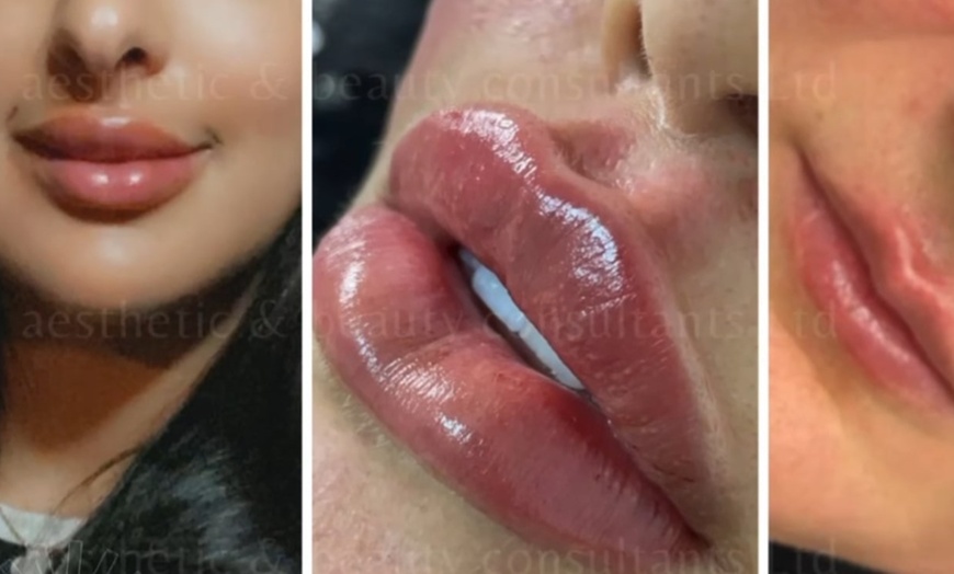 Image 5: Achieve a Natural Look with Dermal Filler 0.5ml, 1ml, or 2ml