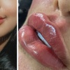 Image 5: Achieve a Natural Look with Dermal Filler 0.5ml, 1ml, or 2ml