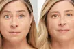 Botox Treatments with Single or Two Sessions, or Botox Plus Restylane at Dr. V's NY Med Spa—Up to 49% Off - Image 2