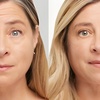 Image 2: Botox Treatments with Single or Two Sessions, or Botox Plus Restylane