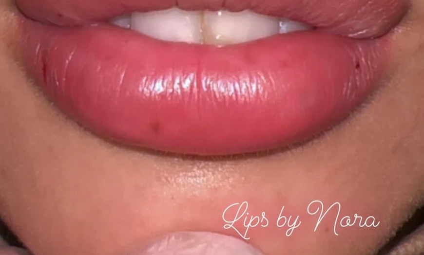 Image 3: Restylane, Sculptra, Radiesse and Kysse for a Fresh Look
