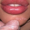 Image 3: Restylane, Sculptra, Radiesse and Kysse for a Fresh Look