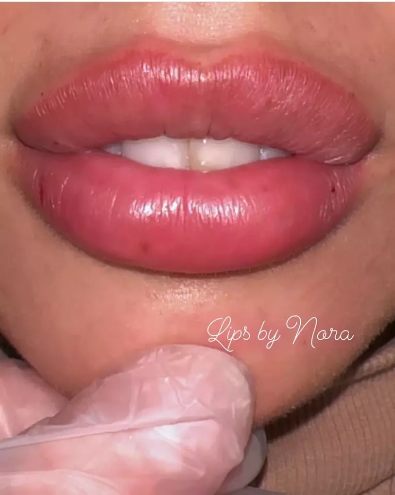 Restylane, Sculptra, Radiesse and Kysse for a Fresh Look