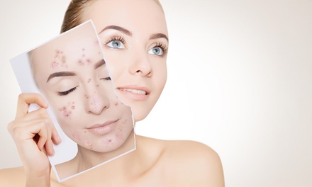 1 sesión de tratamiento láser para manchas y acné - Supreme Beauty Center