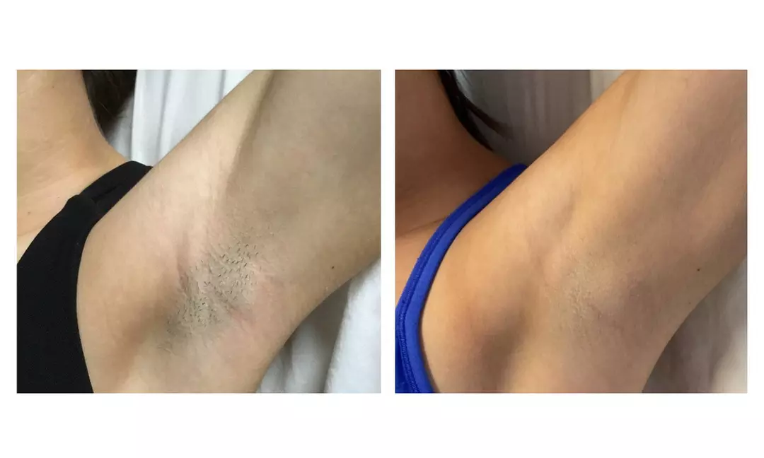 Up to 60% Off on Laser Hair Removal at Prosperi Family Medical - Second Medium