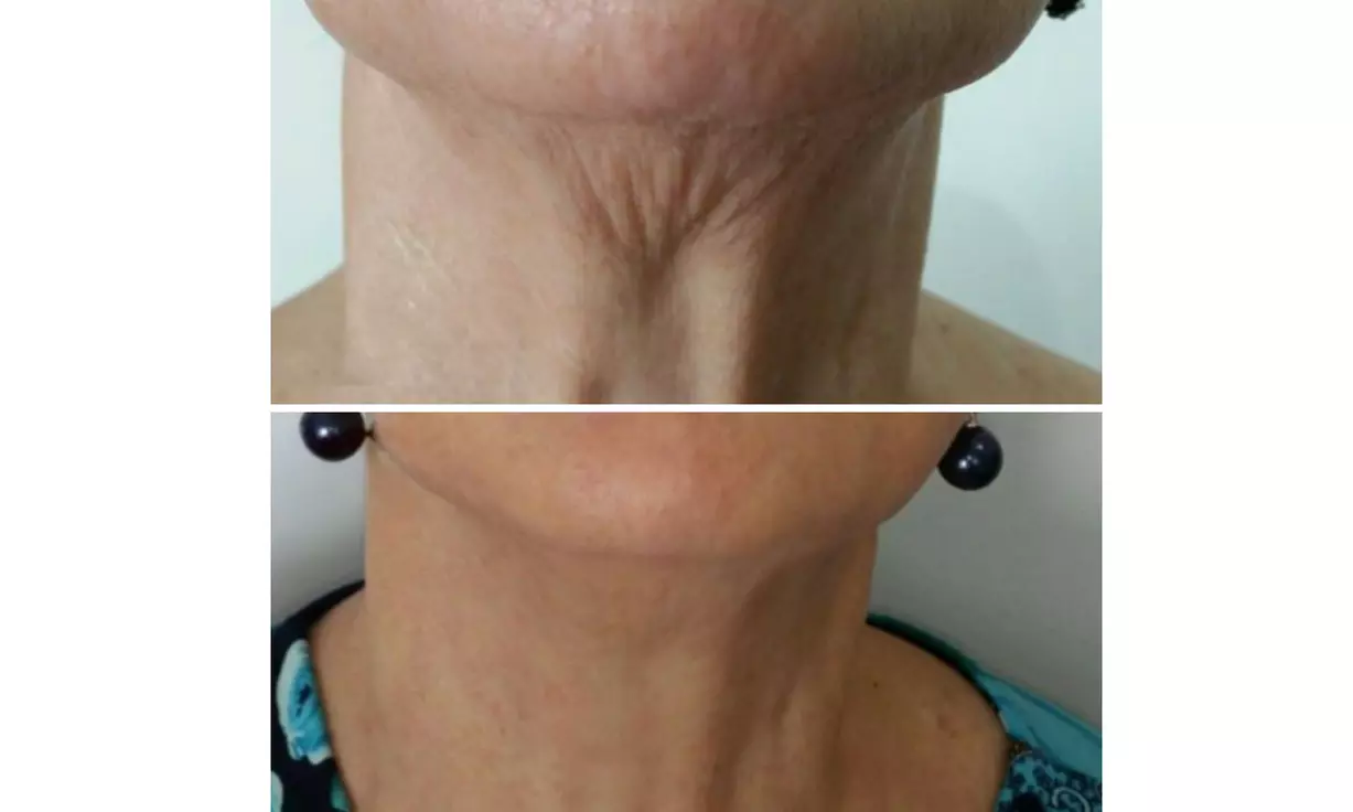 Non-Invasive HIFU Treatments for Crow's Feet, Chin & More