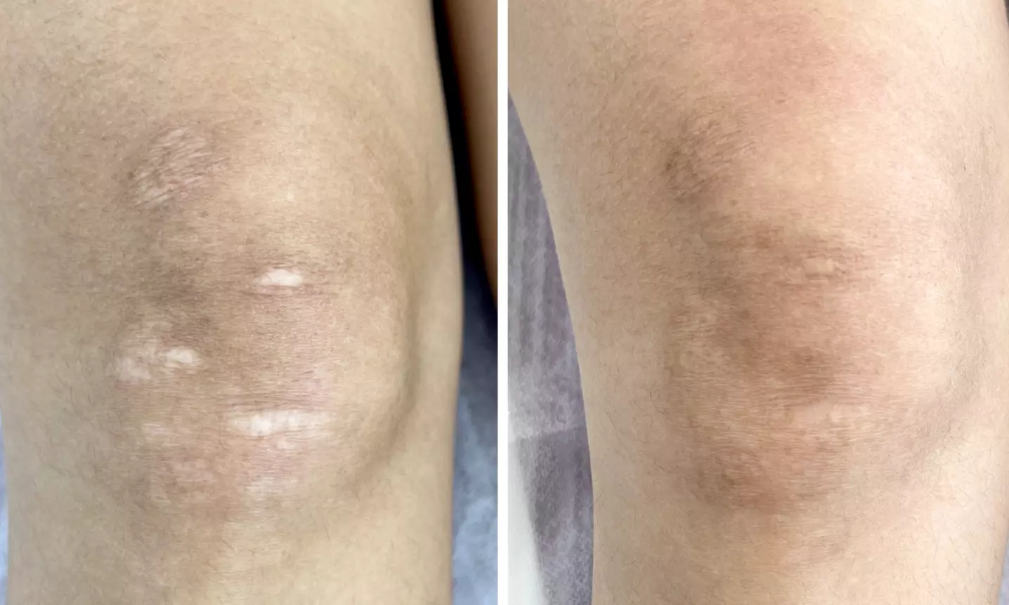 Transform with Stretch Mark Camouflage or Scar Revision/Camouflage