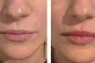 Juvederm Lip Filler Injections at InStudio Aesthetics and Skin- Up to 60% Off - Image 3
