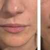 Image 3: Juvederm Lip Filler Injections for Enhanced Natural Beauty 