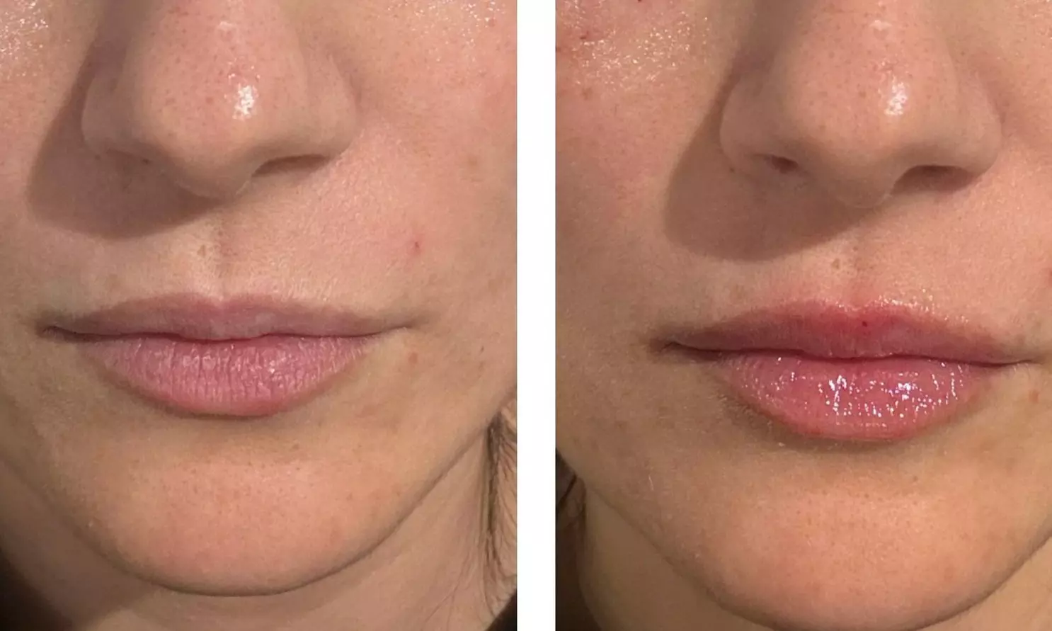 Juvederm Lip Filler Injections for Enhanced Natural Beauty