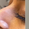 Image 1: One ml Nose Dermal Filler at Dolls Aesthetics 