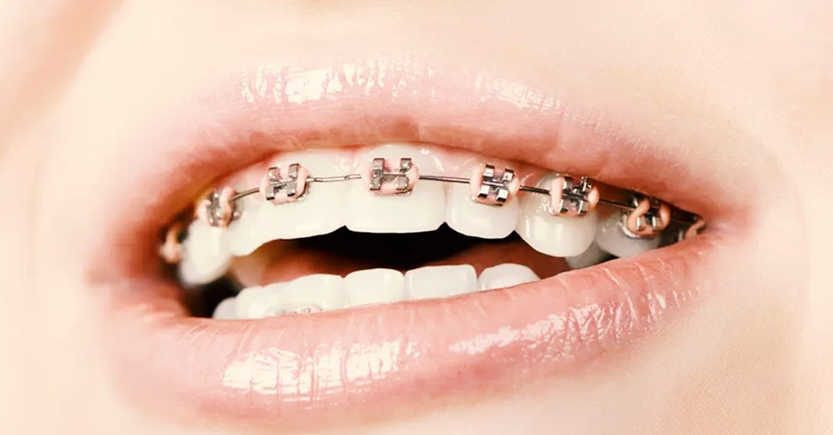 Tratamiento de ortodoncia con brackets en Barcelona