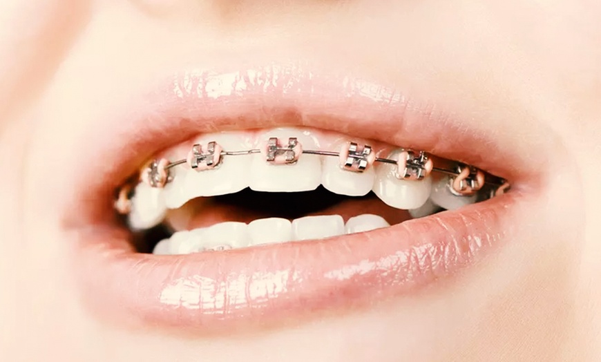 Image 1: Tratamiento de ortodoncia con brackets 