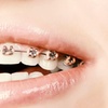 Image 1: Tratamiento de ortodoncia con brackets 