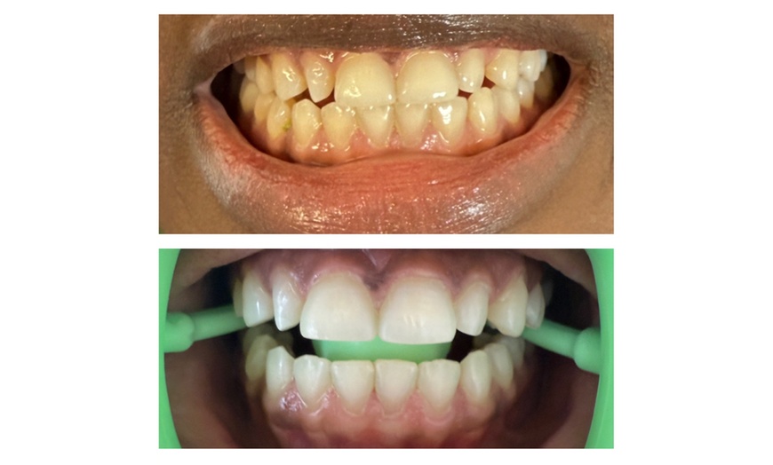 Image 4: Brighten Your Smile with 30 or 60 Minute Teeth Whitening Session 
