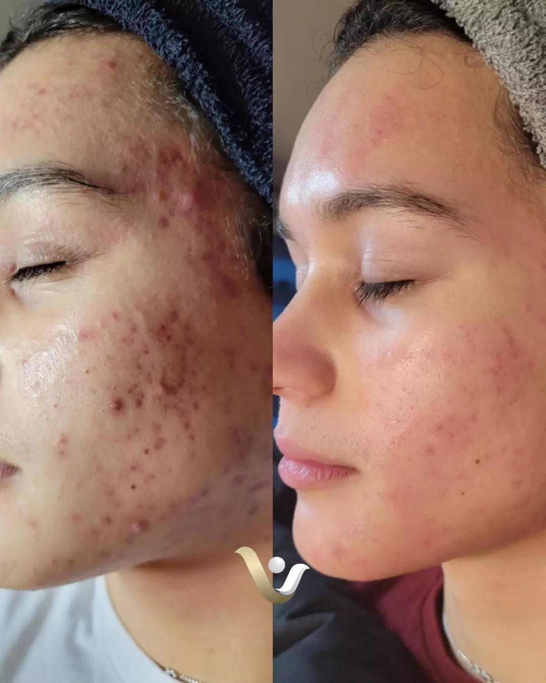 Custom Facials with Dermaplaning Treatments at Vibrance Med Spa (Up to 56% Off) - Primary Image