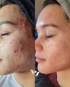 One Custom Facial with Dermaplaning Treatment - Vibrance Med Spa