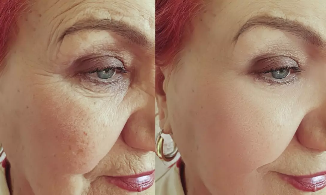 29% Off Botox + Juvederm at Studio Donna Med Spa