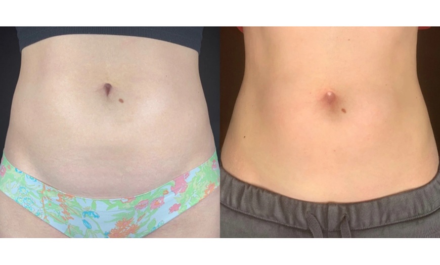 Image 12: Tone with Five Sessions of Body Sculpting - Small or Large Area