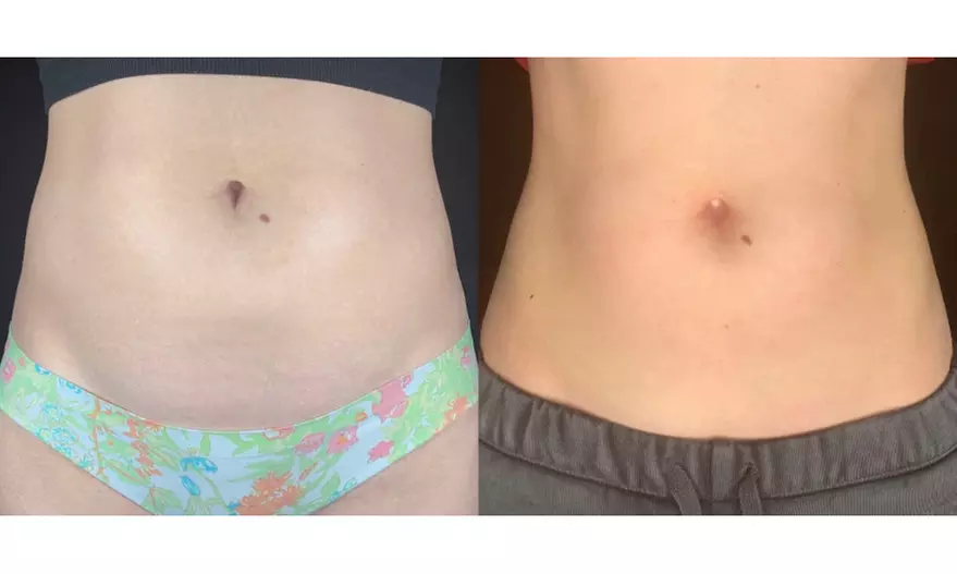 Tone with Five Sessions of Body Sculpting - Small or Large Area