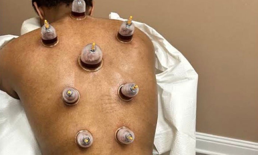 Image 2: 20-Minute 1, 3, or 5 Combination Cupping Sessions: (Wet, Dry & Moving)