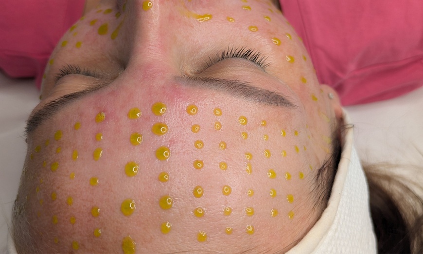 Image 1: Achieve Radiant Skin with One BioRePeel Treatment