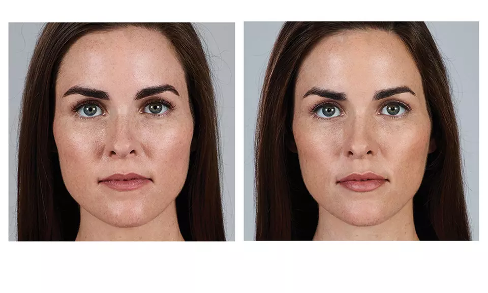 Enhance with 20, 40 Units of Botox or Lip Flip (Up to 10 Units)