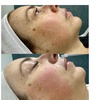 Image 4: Experience IPL Photofacial for Skin Renewal