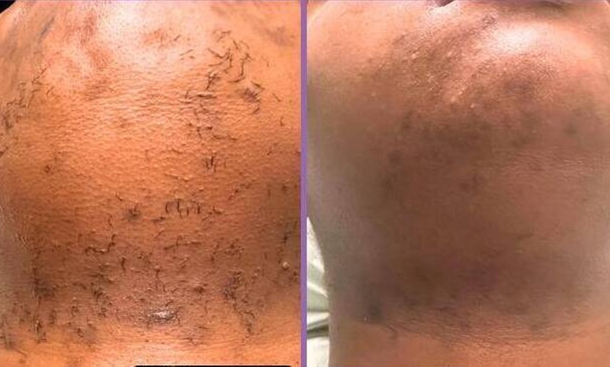 Image 2: Get Smooth Skin with Laser Hair Removal Treatments