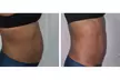 Melt fat and Tighten Skin w/ 1, 3, 6 ( 60 min) Ultrasonic Cavitation, RF & Laser Lipo Sessions (Up to 54% Off) - Second Medium