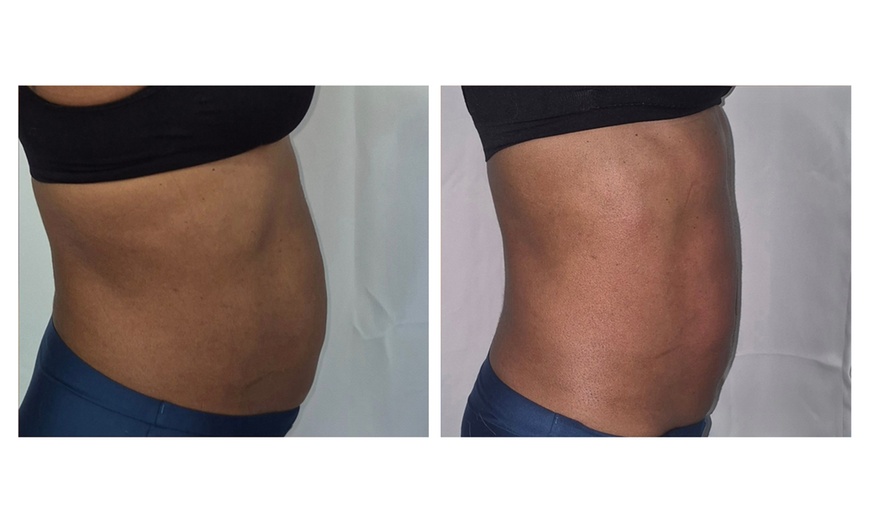 Image 4: Get 1, 3, or 6(60 Min) Ultrasonic Cavitation, RF & Laser Lipo Sessions