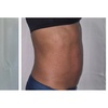 Image 8: Get 1, 3, or 6(60 Min) Ultrasonic Cavitation, RF & Laser Lipo Sessions