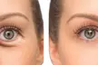 Zen Beauty – Non-Surgical HIFU Facelift & Eye/Mouth Lift: Up to 67% Off - Second Medium