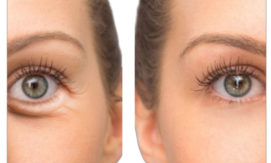 Image 4: Up to 67% Off on Facelift - Non-Surgical at Zen Beauty Ltd