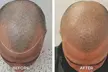 Get Hair Restoration Scalp Micropigmentation : 1 Spot/Partial or Full Head (Up to 60% Off) - Second Medium
