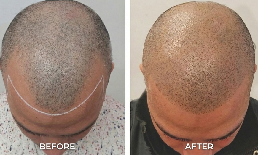 Image 5: Hair Restoration Scalp Micropigmentation : 1 Spot/Partial or Full Head
