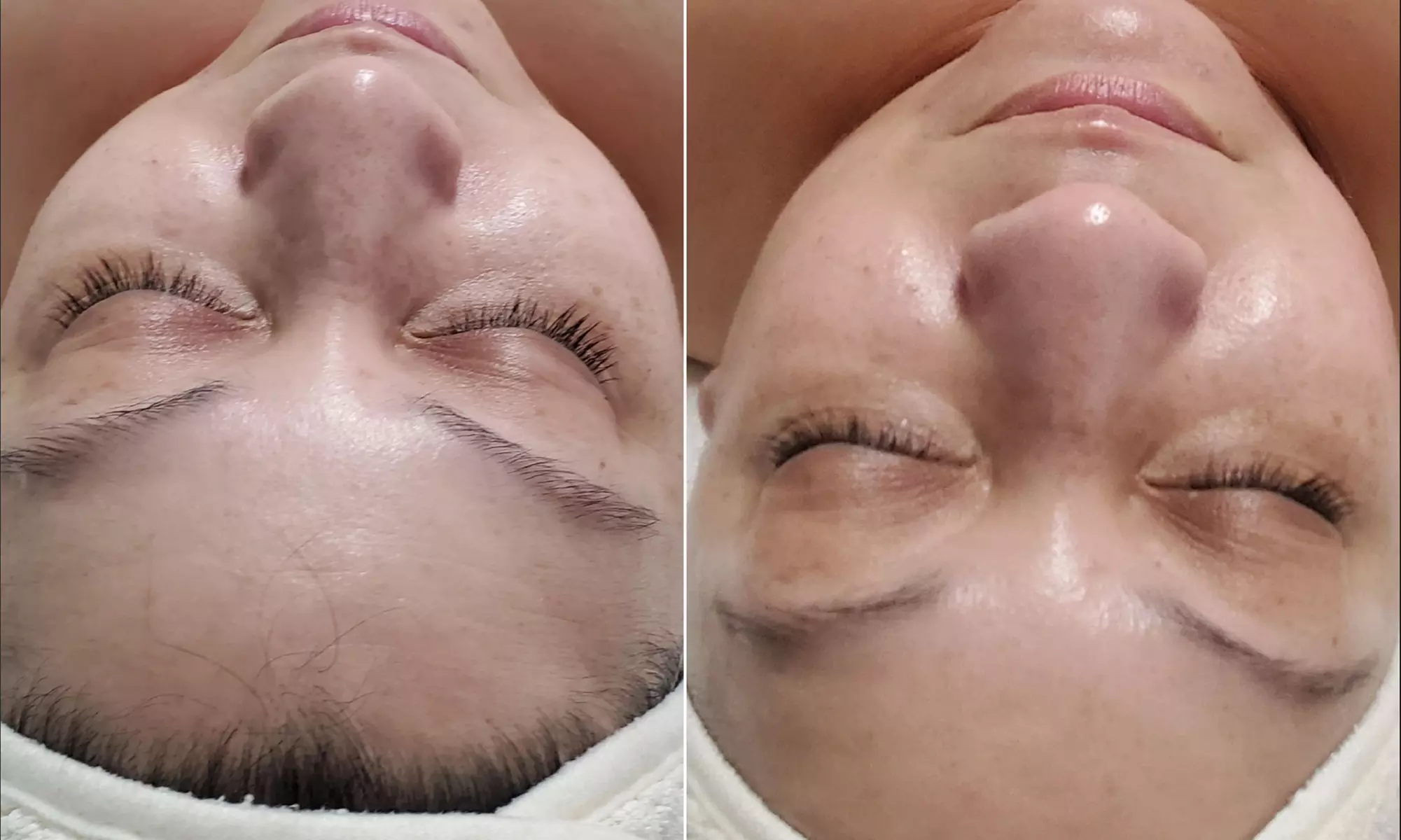 Microdermabrasion with Optional Facial Mask & Shoulder Relaxation