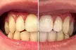 Get Teeth Whitening at Smile in Style With Carbamide Peroxide for a Dazzling Smile (Up to 55%) - Second Medium