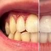 Image 2: Teeth Whitening with Carbamide Peroxide