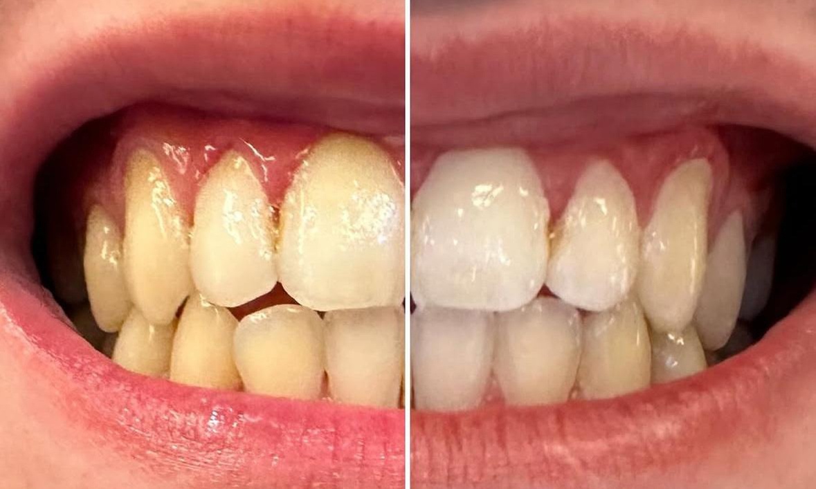 Teeth Whitening with Carbamide Peroxide